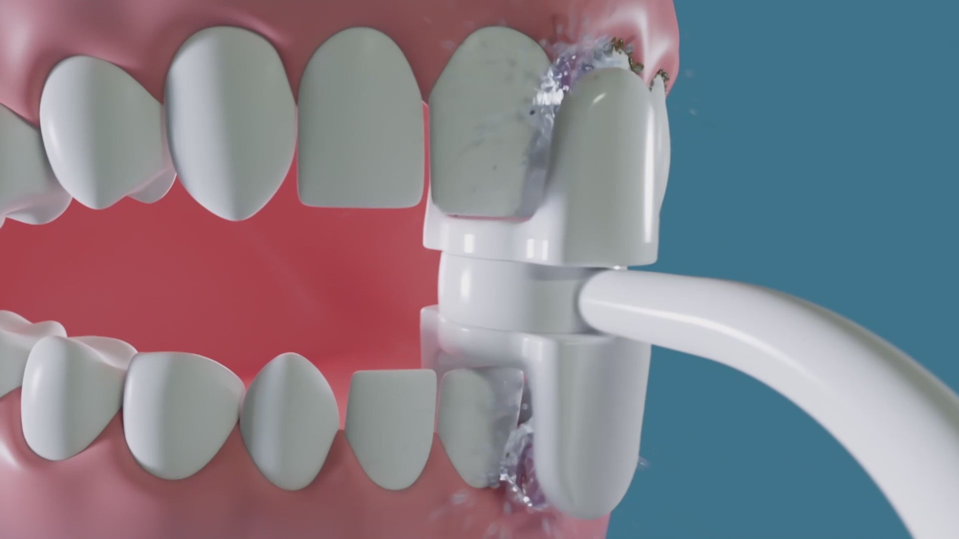 Miracle Smile - Irrigador dental doble